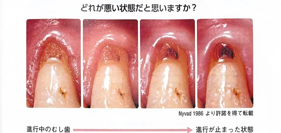 虫歯の進行度合い