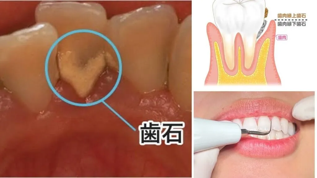 歯石除去