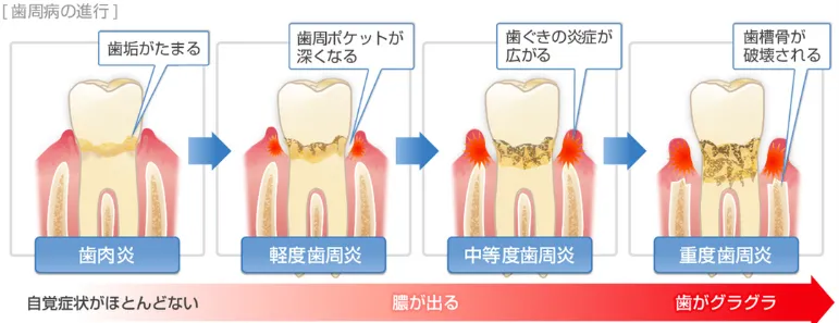 汚れを放置した時の歯ぐきの変化