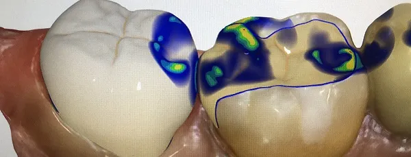 セレックのスキャンデータ